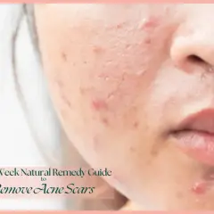 Skóra z widocznymi śladami po trądziku, bliznami i zaczerwienieniami. Poradnik "One-Week Natural Remedy Guide to Remove Acne Scars" sugeruje, co na kaszkę na twarzy.